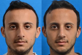 Male Primary Reduction Rhinoplasty Nose Job Surgery 1080966
