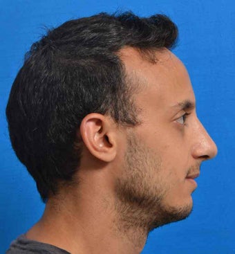 Male Primary Reduction Rhinoplasty Nose Job Surgery after 1080966