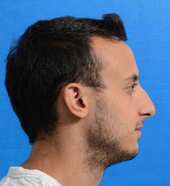 Male Primary Reduction Rhinoplasty Nose Job Surgery before 1080966