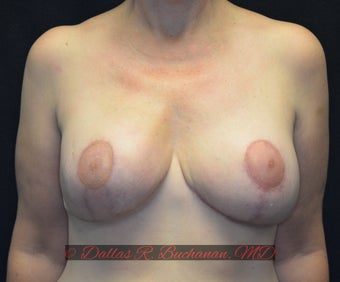 48 year old woman treated with Breast Reconstruction after 3319992