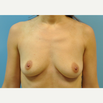 30 year old woman treated with Breast Augmentation, silicone 430 cc ultra high profile before 3508244