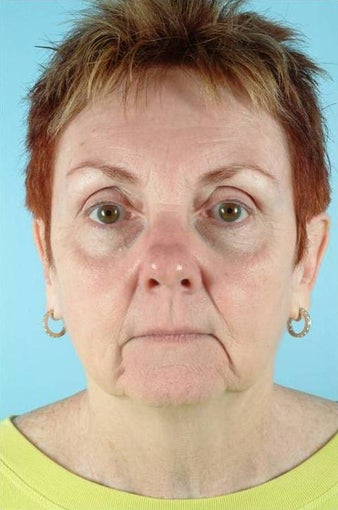 62 Year Old Female Treated for Unwanted Facial Lines before 1016583