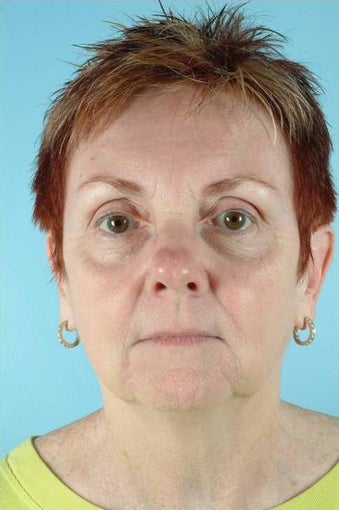 62 Year Old Female Treated for Unwanted Facial Lines after 1016583