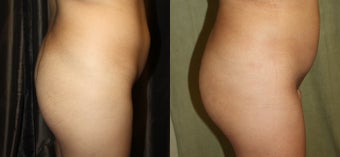 Brazillian Butt Lift before 1184694