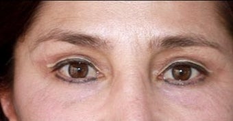 45-54 year old woman treated with Chemical Peel after 3417663