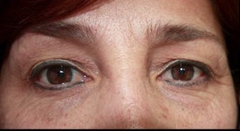 45-54 year old woman treated with Chemical Peel before 3417663