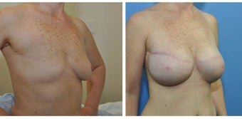 620g anatomic (teardrop) cohesive gel implant – bilateral 2 stage expander-implant breast recontruction after 1210491