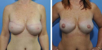 620g anatomic (teardrop) cohesive gel implant – bilateral 2 stage expander-implant breast recontruction before 1210491