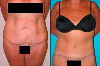Tummy Tuck before 3037979