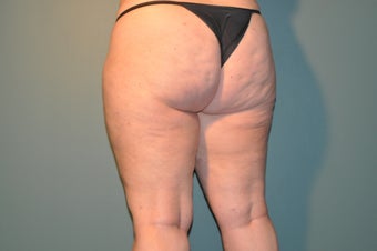 Cellulaze after 1098246