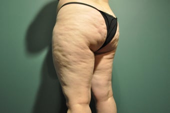 Cellulaze before 1098246