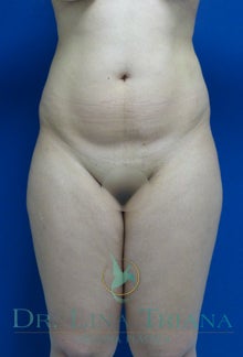 Liposculpture, Lipo Laser or Laser Lipolysis before 992577