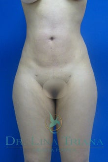 Liposculpture, Lipo Laser or Laser Lipolysis after 992577