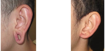 Gauge earlobe hole repair before - Gauge earlobe hole repair 10 days after surgery before 969043