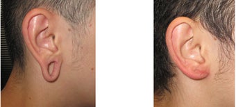 Gauge earlobe hole repair before - Gauge earlobe hole repair 10 days after surgery after 969043