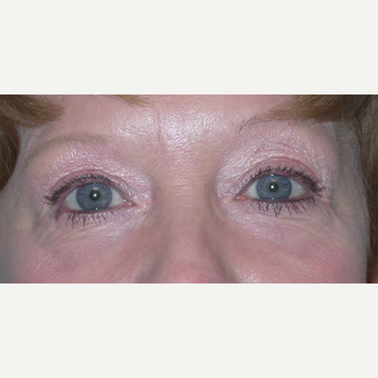 45-54 year old woman treated with Eyelid Surgery after 3074602