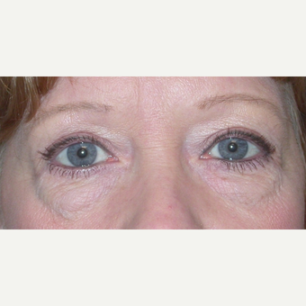 45-54 year old woman treated with Eyelid Surgery before 3074602