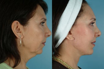 SMAS Facelift before 1343708