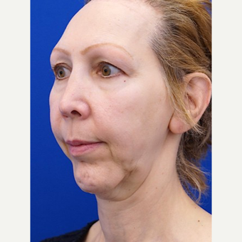 45-54 year old woman treated with Facelift before 3653448