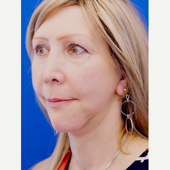 45-54 year old woman treated with Facelift after 3653448