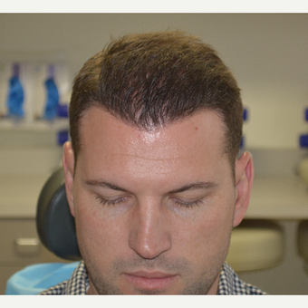 35-44 year old man treated with FUE Hair Transplant after 3065707