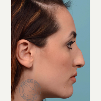 18-24 year old woman treated with Rhinoplasty before 3092555