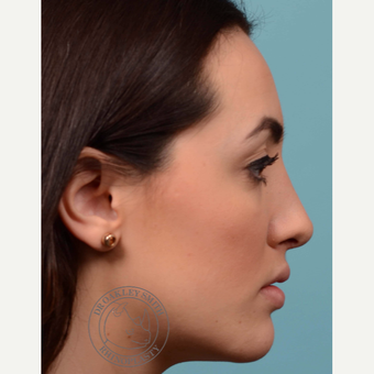 18-24 year old woman treated with Rhinoplasty after 3092555