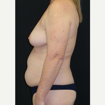 45-54 year old woman treated with Mommy Makeover before 3306131