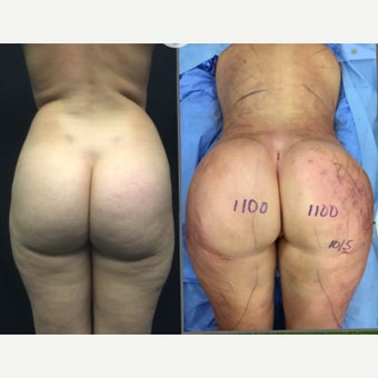 25-34 year old woman has Brazilian Butt Lift Revision before 2256236