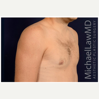 25-34 year old man treated with Male Breast Reduction after 3536863