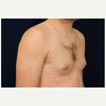 25-34 year old man treated with Male Breast Reduction before 3536863