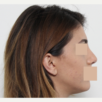 25-34 year old woman treated with Rhinoplasty after 3442473