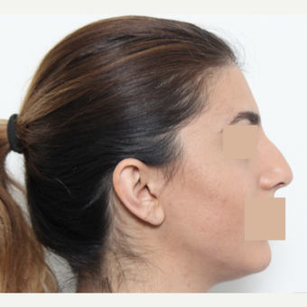 25-34 year old woman treated with Rhinoplasty before 3442473