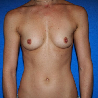 25-34 year old woman treated with Breast Augmentation before 3497263