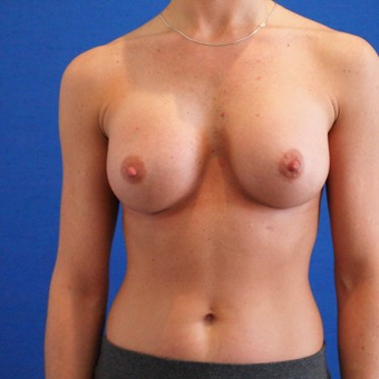 25-34 year old woman treated with Breast Augmentation after 3497263