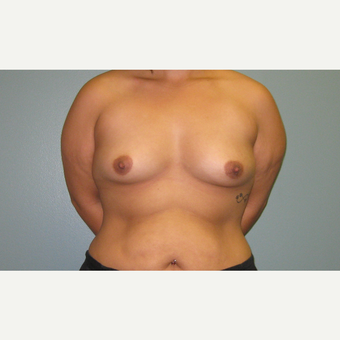 25-34 year old woman treated with Breast Augmentation before 3253913