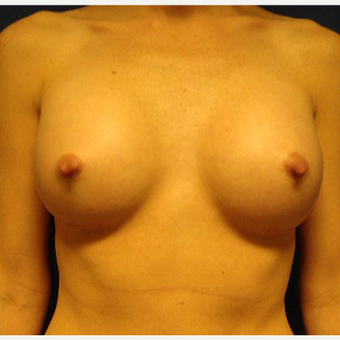 25-34 year old woman treated with Breast Implants after 3670847