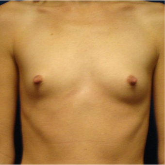 25-34 year old woman treated with Breast Implants before 3670847
