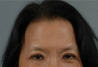 45-54 year old woman treated with Asian Eyelid Surgery after 3615931