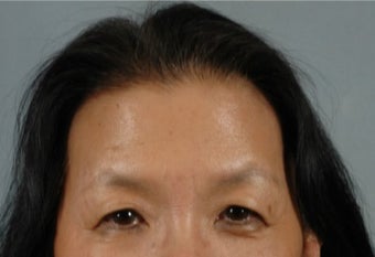 45-54 year old woman treated with Asian Eyelid Surgery before 3615931