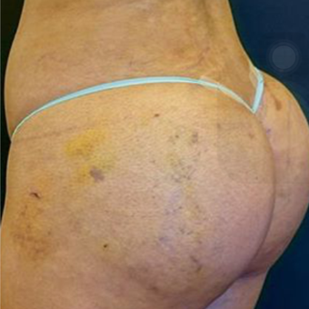 18-24 year old woman treated with Brazilian Butt Lift after 2574558