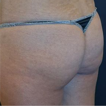 18-24 year old woman treated with Brazilian Butt Lift before 2574558