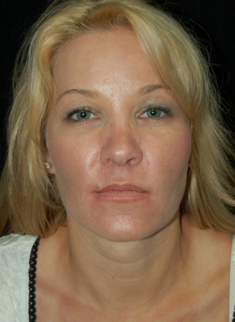 Cheek Fat Pad Removal after 1252280