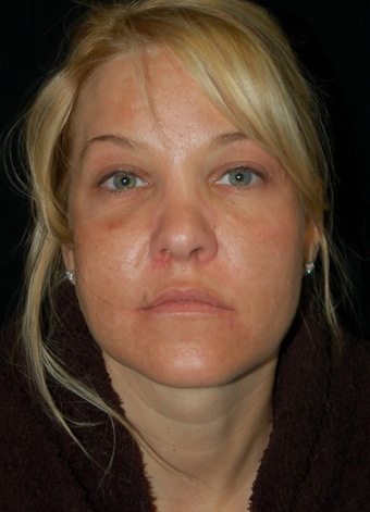 Cheek Fat Pad Removal before 1252280