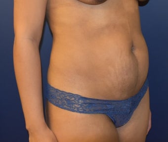 35-44 year old woman treated with Liposuction before 3348726