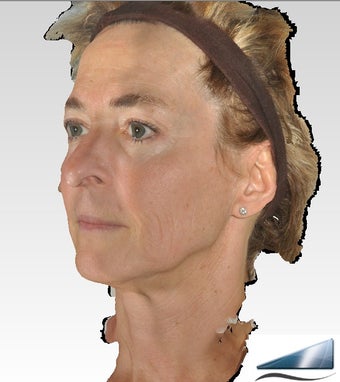 Infini Microneedling Radiofrequency Wrinkle Treatment after 1275856