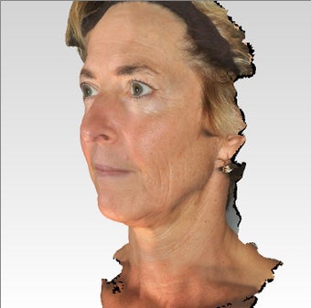 Infini Microneedling Radiofrequency Wrinkle Treatment before 1275856