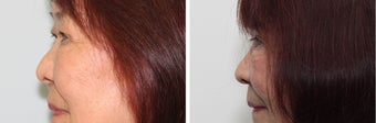 Before and 2 month after double eyelid surgery 683360