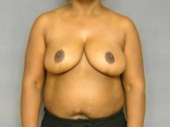 Age: 49, Height: 5"2", Weight: 199lbs. after 1124557