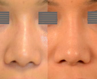 Non-surgical rhinoplasty (nose job) to straighten and improve dorsal aesthetic lines (straighten bridge) before 1398908